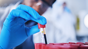 گروه خونی که بیشتر از همه سکته مغزی می‌کند!